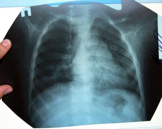 Pneumonia Aufnahmen für Pneumonie