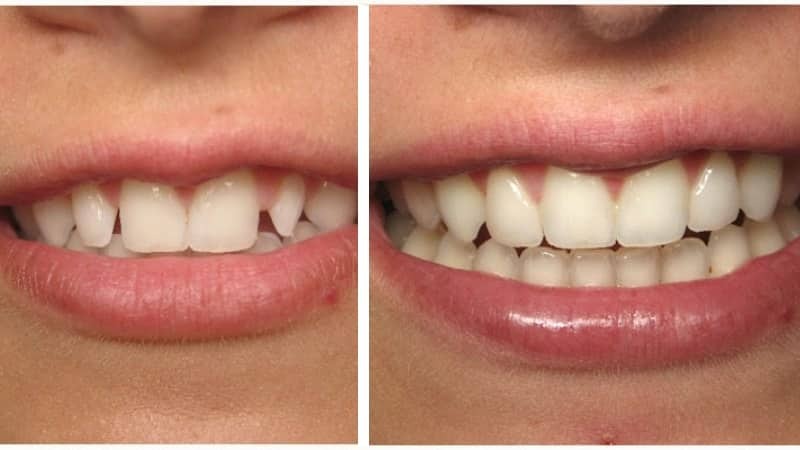 Ceramiczne zębów przed i po zdjęcia z koronami