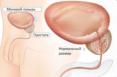 Clínica de la prostatitis infecciosa