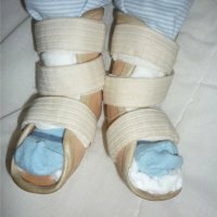 Strek af fodens ligament