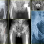 Manifestación de la cadera anomalías en la radiografía
