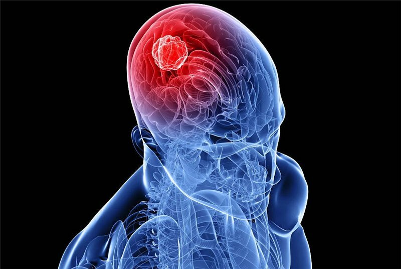 Hvilke sykdommer oppdages ved hjelp av MR i hjernen?