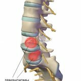 Síntomas del hemangioma espinal y su tratamiento