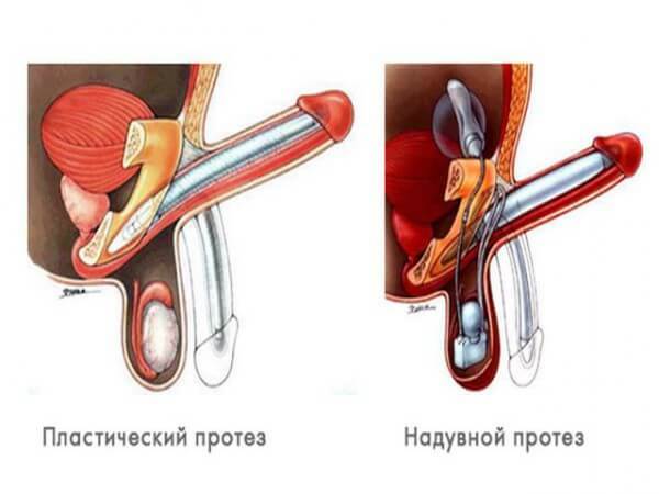 Oleogranulema pene: Causas, síntomas y tratamiento