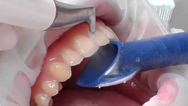 Mekanisk rengöring av tänder hemma