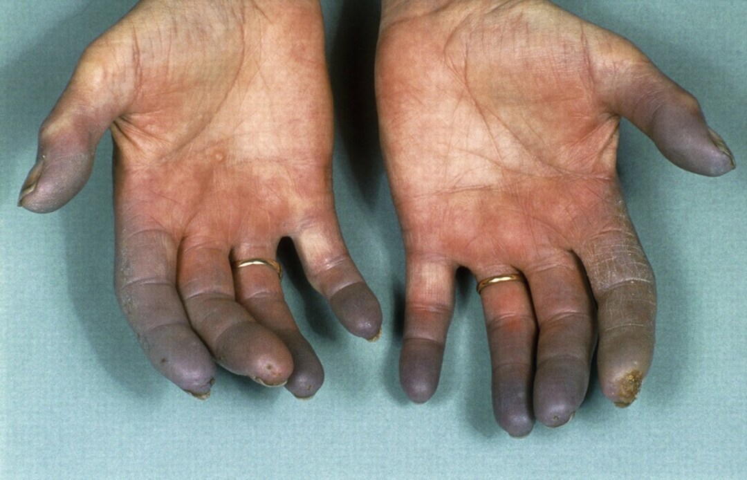 Doença de Buerger (tromboangeíte obliterante): causas, sintomas, tratamento