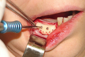 I hvilke situasjoner er utført av tannleger bygge kjevebenet?