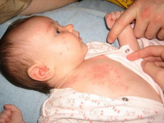 Wie die stachelige Hitze von Allergien, ihre Ursachen und Behandlung unterscheiden