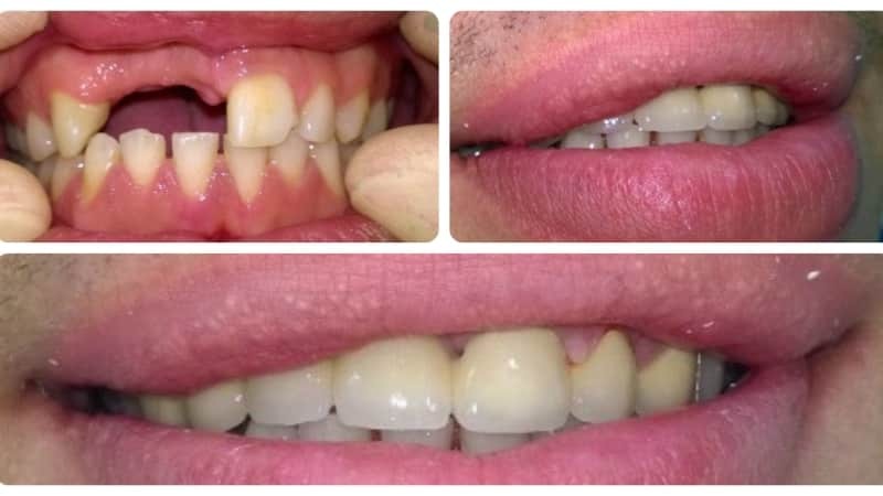 Kwetst of de tand implantaat voegen