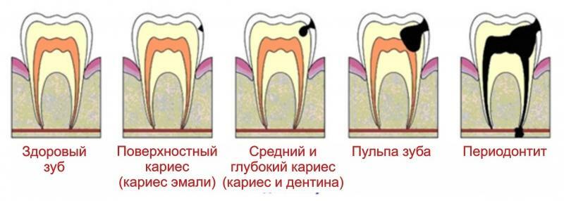 Ja zobs ir zaudēts, un mīkstumu rūpīgi pārsteigti, ņem slimības zobu izņemšanu