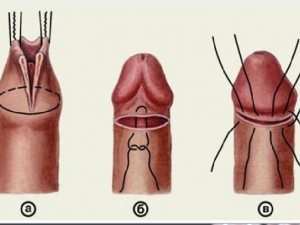 Como a circuncisão é feita
