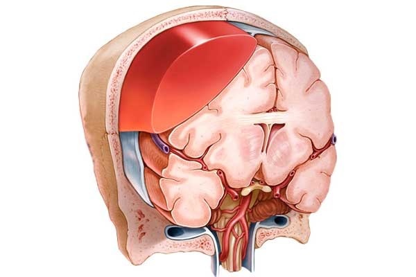Hematoma cerebral epidural