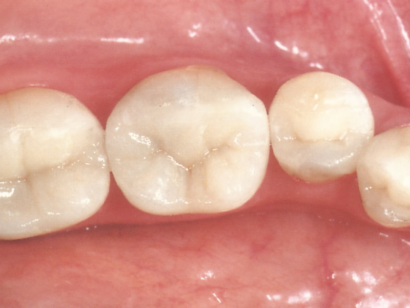 Výhody zuby Kapacita