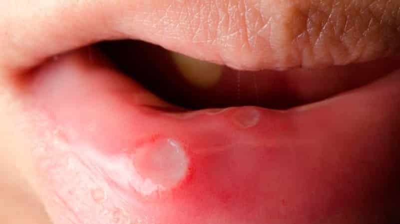 Antibiotics for stomatitis in children and adults - expediency of their use