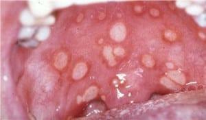 תמונה 3. stomatitis זיהומיות