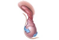 Torsion af testikulære hydatider og epididymier