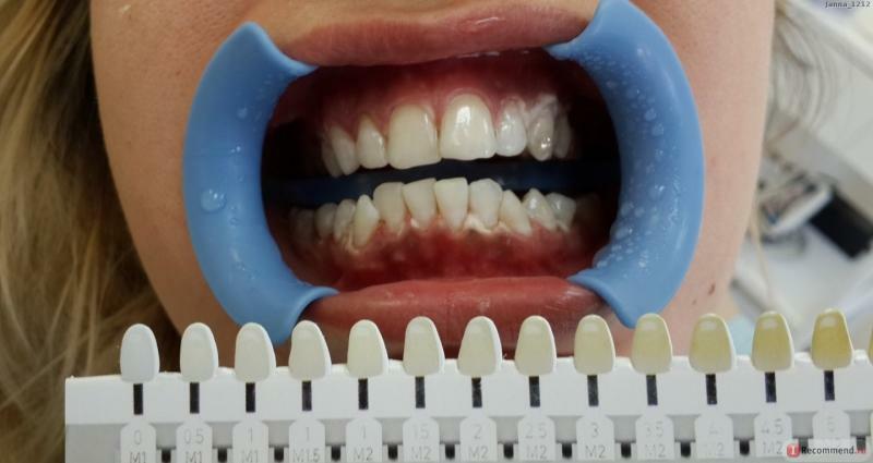 ¿Es perjudicial para blanquear los dientes, contraindicaciones