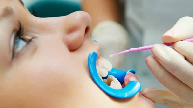 Fluoridering tanden: wat het is, voor en na foto's