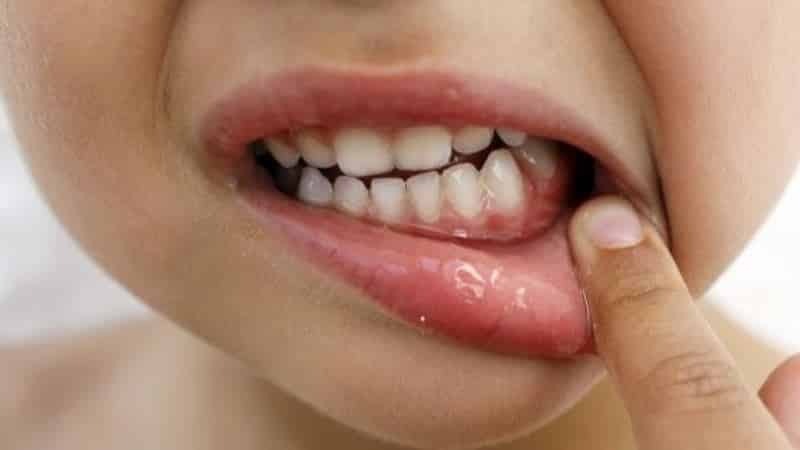 Es ist nicht die Wunde auf dem Zahnfleisch heilen