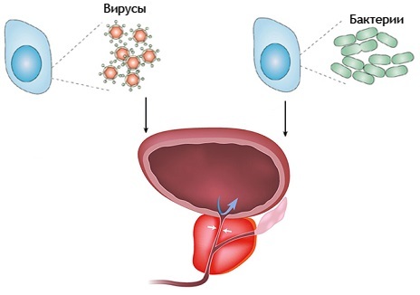 Causas de la prostatitis bacteriana