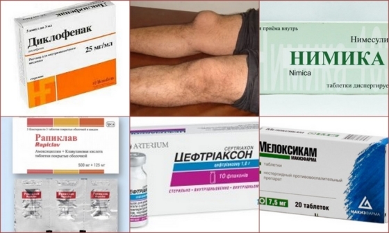 Wie behandeln Bursitis des Kniegelenks in der Heimat: Medikamente, Volksmedizin, Massage, Ernährung