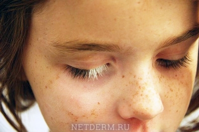 Symptom på vitiligo hos barn