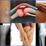 Osteophytes Knie auf den Fotos und Röntgenstrahlen