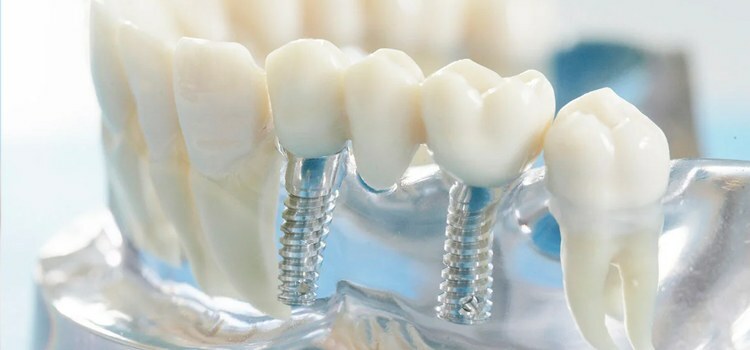 Contraindicaciones para la implantación dental.