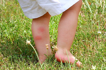 Allergi til insektbid på børn