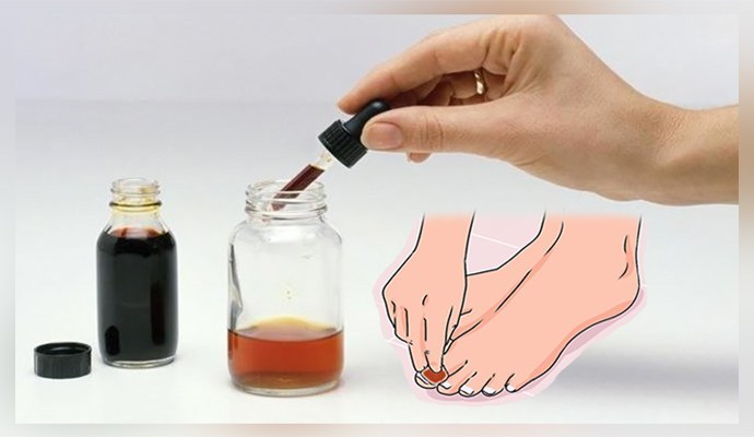 Behandling av nagelsvamp med jod och ättika