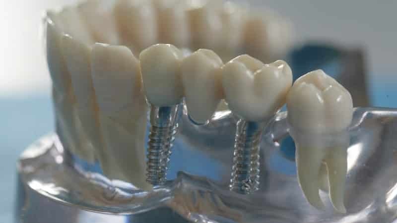 Protesimplantat: stegen i total avsaknad av tänder