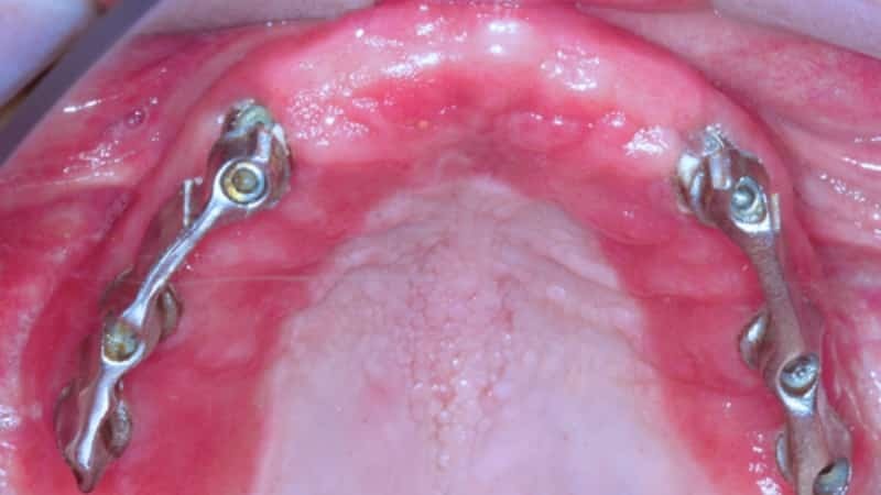 alergias a prótese dentária