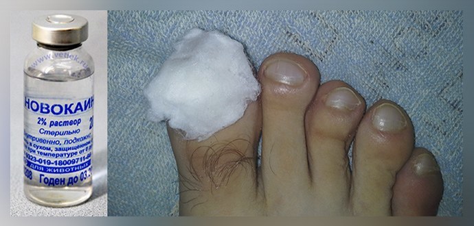 Trattamento del fungo delle unghie con novocaina sui piedi: ricette, recensioni