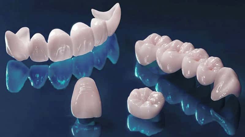 Implantācija no priekšējās zobu Pirms un pēc