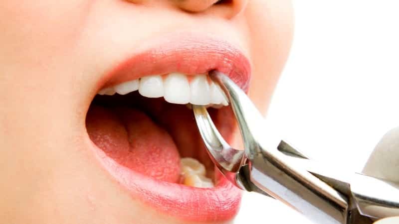 cyste i tand tyggegummi behandling foto symptomer