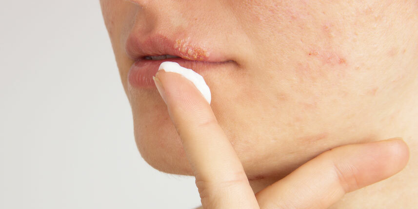 Hur hjälper salva Fenistil från herpes på läpparna?