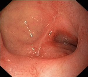 Duodenal bulb ulcer: symptoms and treatment