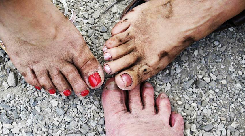 Ursachen von Fußpilz Aussehen