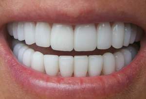 I denti devono apparire eleganti e ekstetichno