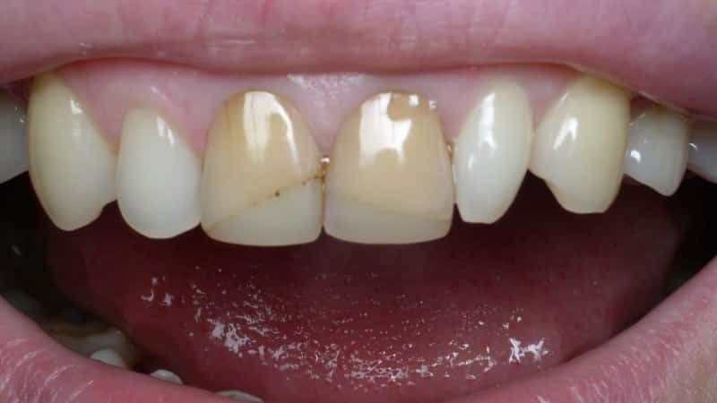 zubní protézy po načasování zubu