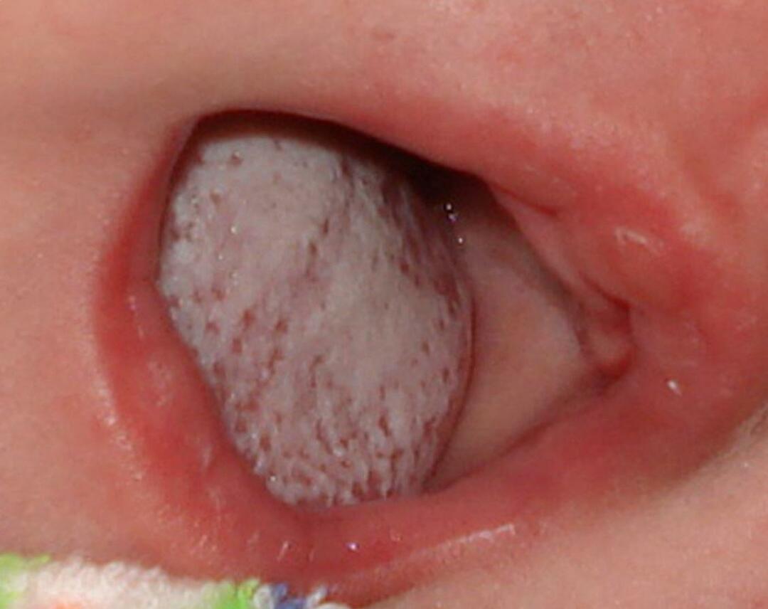 Candidiasis hos spädbarn i munnen: behandling av bilder och symptom