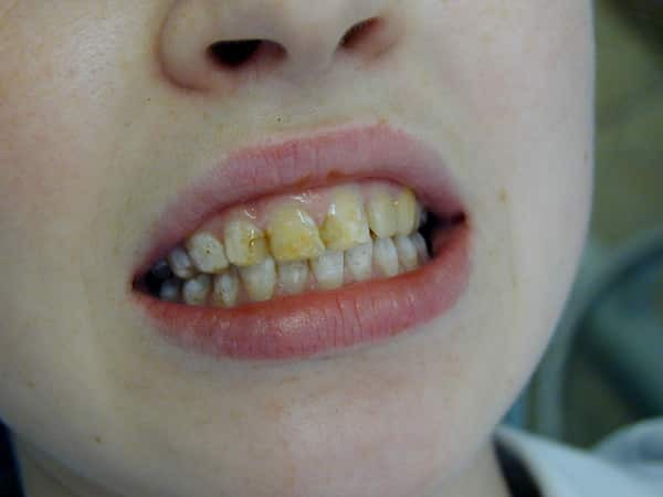 Miksi mustata hampaitaan vuotias lapsi