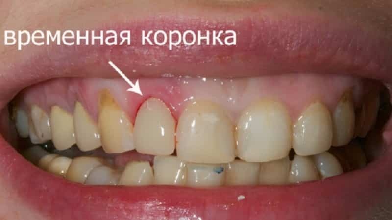 Привремене крунице на предње зубе и колико фотографије које могу да носе