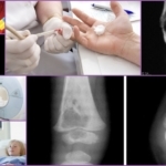 Die Diagnose der Osteomyelitis bei Kindern