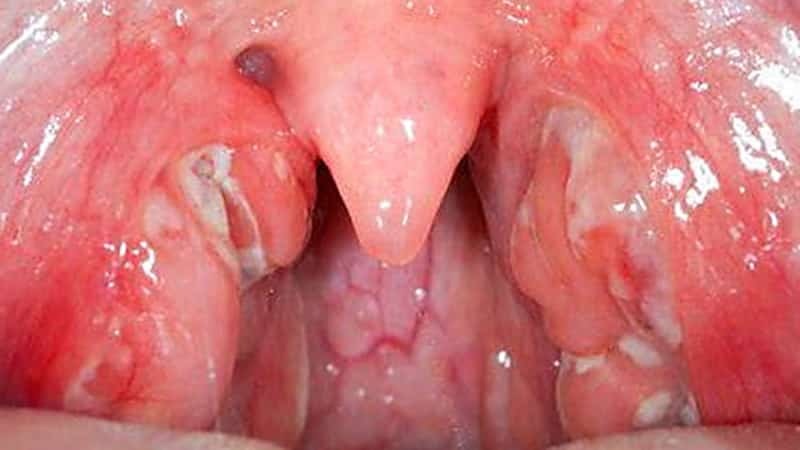 Tonsillære hvite prikker i barnet: hva det er og hva behandling