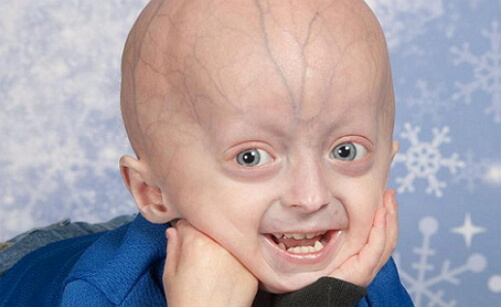 Progeria vrtec