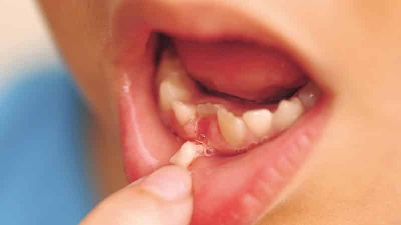 sostituzione di denti decidui da costanti circuitali