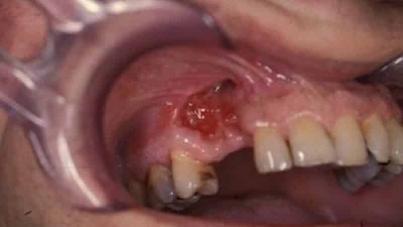 zub osteomyelitída
