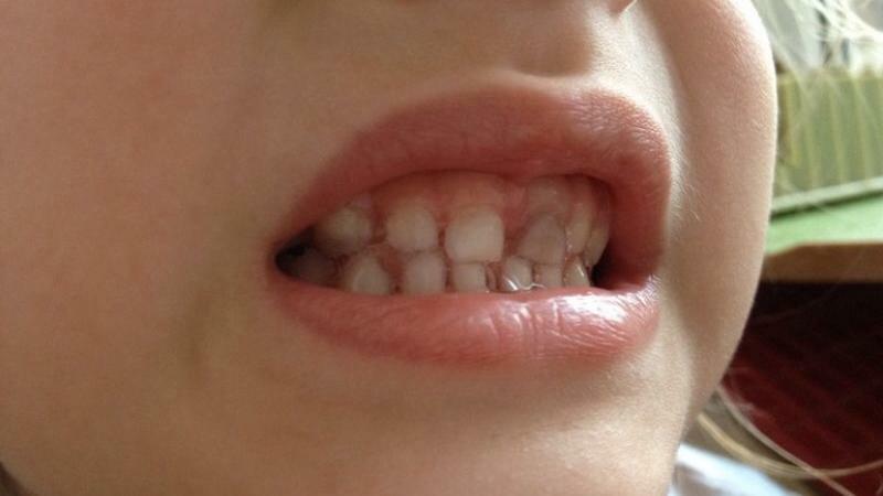 dente da latte oscurato dopo aver colpito