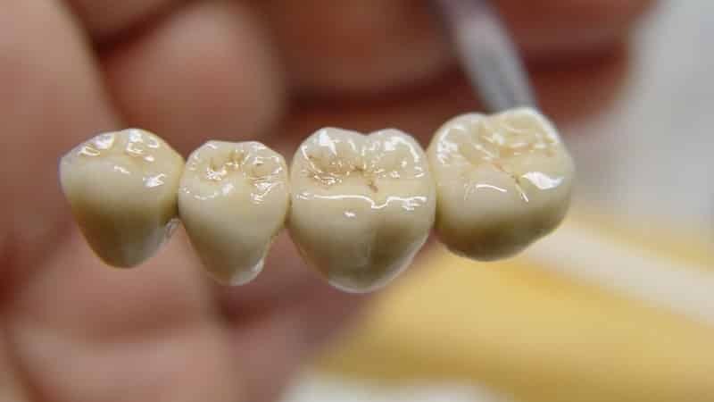 Zobu implantu: Cik daudz ir implantācija